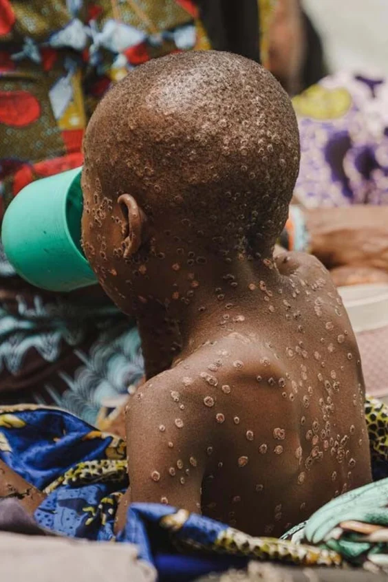 Ein an Mpox erkranktes Kind in der Mpox-Isolierstation eines von UNICEF unterstützten Spitals in der Provinz Süd-Kivu, in D.R.Kongo, am 23. Juli 2024.