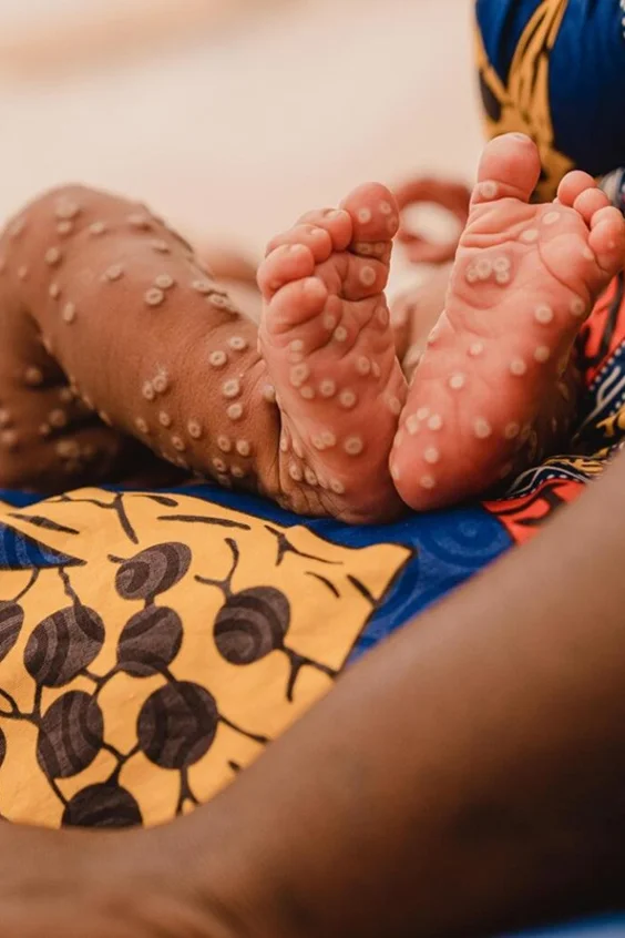 Aline* (1 Monat alt) in den Armen ihrer Mutter auf der Mpox-Isolierstation in einem von UNICEF unterstützten Spital in der Provinz Süd-Kivu, D.R. Kongo, am 24. Juli 2024. *Name geändert